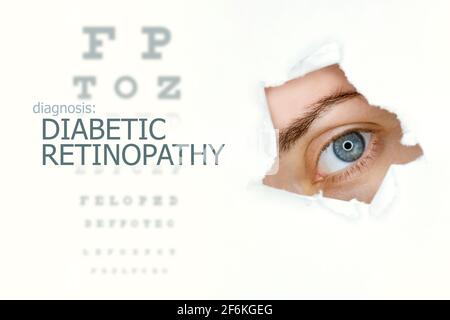 Woman`s eye looking trough teared hole in paper, eye test with words Diabetic Retinopathy on left. Eye disease concept template. Isolated  background. Stock Photo
